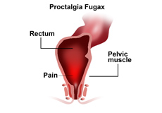 Proctalgia Fugax